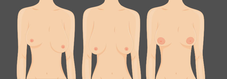 علت و درمان نامتقارن بودن سینه ها در زنان