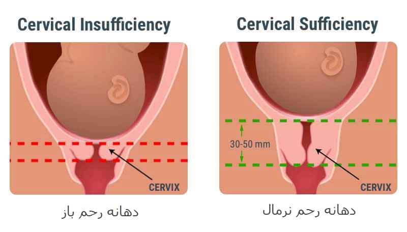 کوتاهی طول سرویکس
