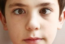 دوبینی چشم در کودکان