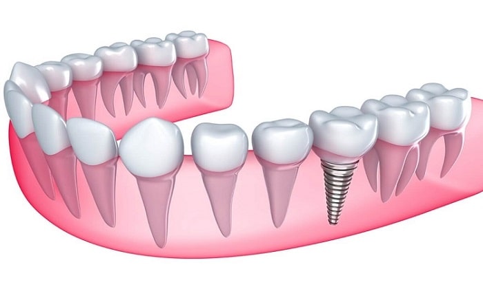 عمر ایمپلنت دندان