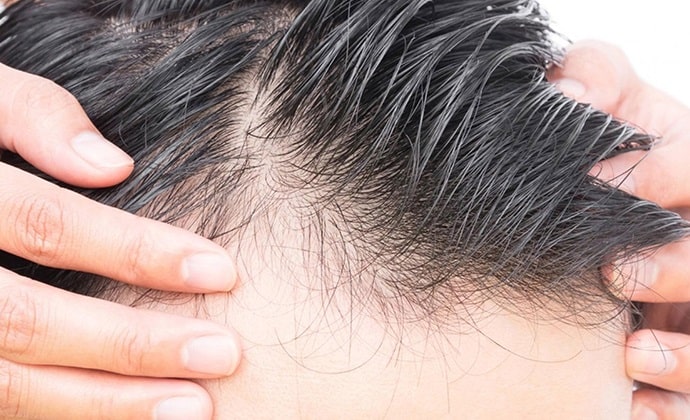 آیا نتیجه کاشت مو دائمی است؟
