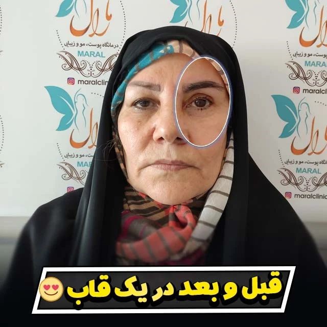 بهترین دکتر عمل بلفاروپلاستی در تهران