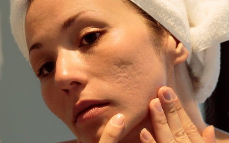 از بین بردن جای جوش برای همیشه-کلینیک زیبایی الیزه