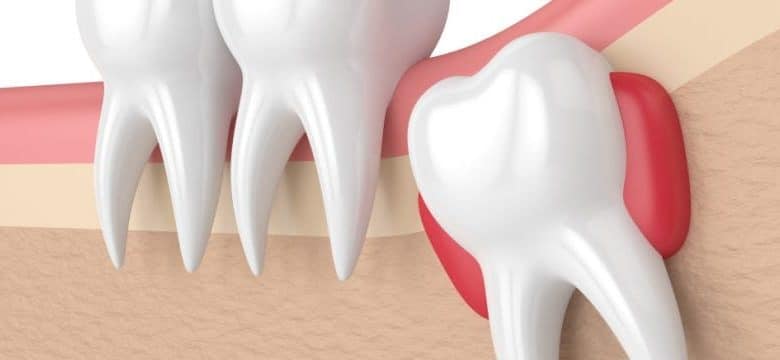 اگر دندان عقل را نکشیم چه می شود؟