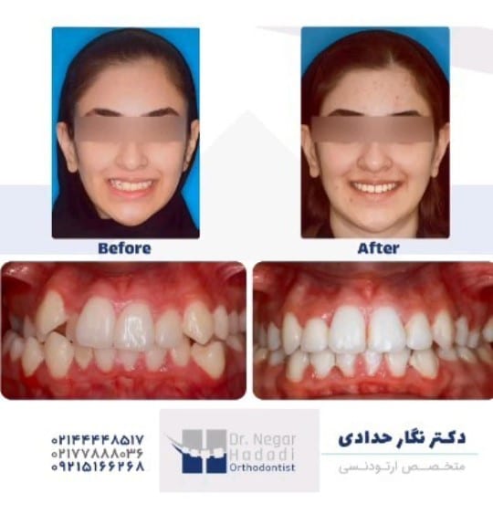 ارتودنسی دندان فاصله دار2