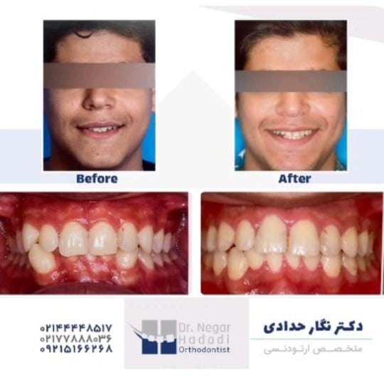 ارتودنسی دندان فاصله دار3