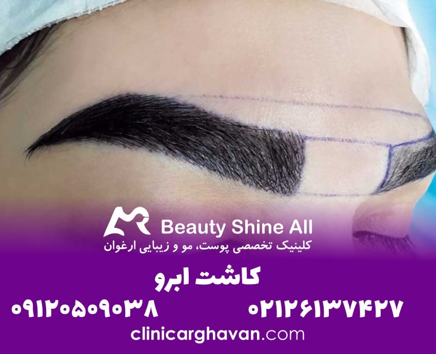 کاشت ابرو چیست، چطور انجام می شود؟