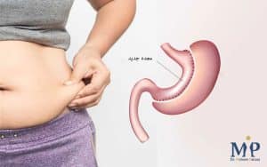 اسلیو معده،بهترین روش لاغری اسلیو معده با دکتر پاکزاد