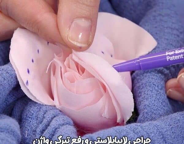 آیا لابیاپلاستی در رفع تیرگی واژن مؤثر است؟