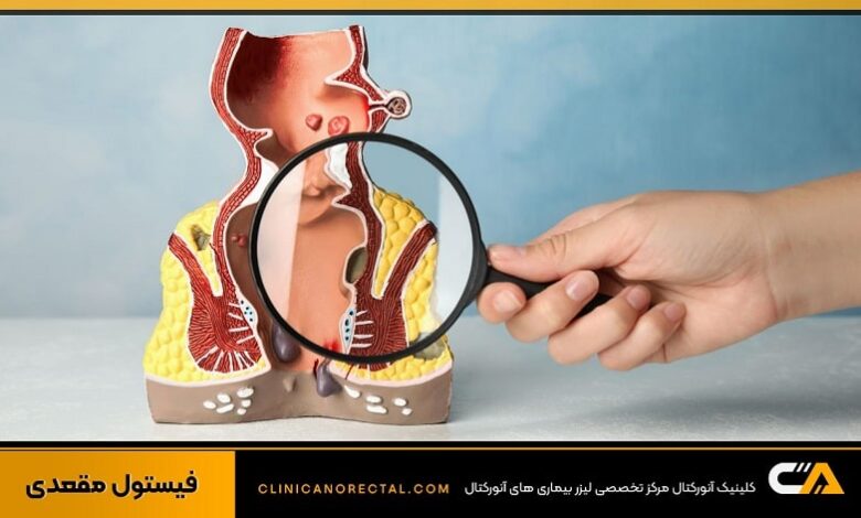 انواع روشهای درمان فیستول