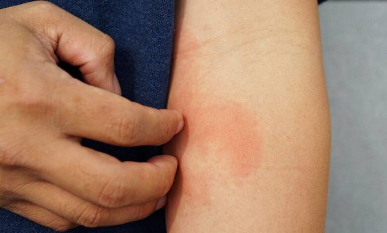 در صورت مشاهده لک قرمز روی پوست به کجا مراجعه کنیم؟