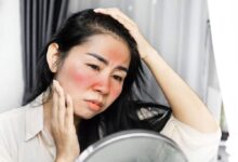 چگونه لک آفتاب سوختگی صورت را درمان کنیم؟