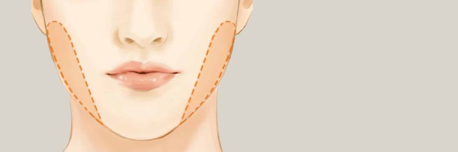 ماندگاری عمل بوکال‌ فت چقدر است؟