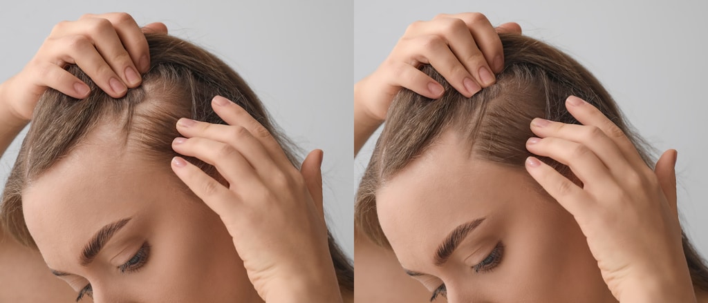 Woman before and after hair loss treatment on grey background, closeup - Photo, Image