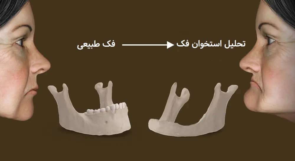 تحلیل استخوان فک و ایمپلنت دندان؛ همه آنچه باید بدانید - تصویر 1 تحلیل استخوان فک و ایمپلنت دندان؛ همه آنچه باید بدانید