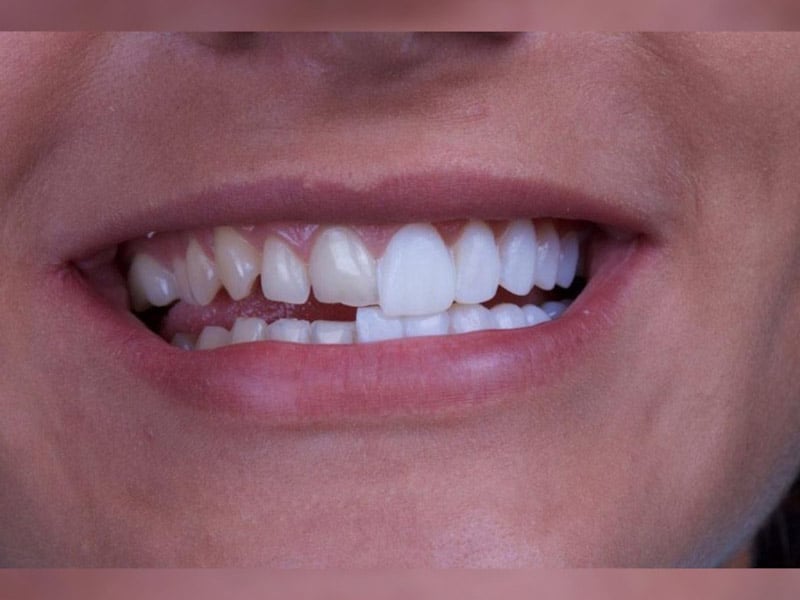 روش های مرتب کردن دندان ها کدامند؟ - تصویر 3 روش های مرتب کردن دندان ها کدامند؟