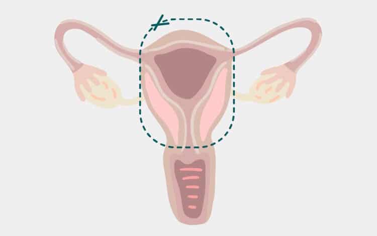 جراحی درآوردن رحم چیست؟