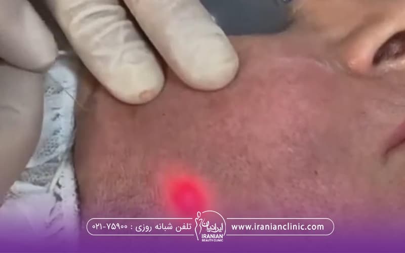 مردی که خوابیده است و عینک مخصوص به چشم دارد و دستان دکتر در حال انجام اندولیفت صورت مرد است
