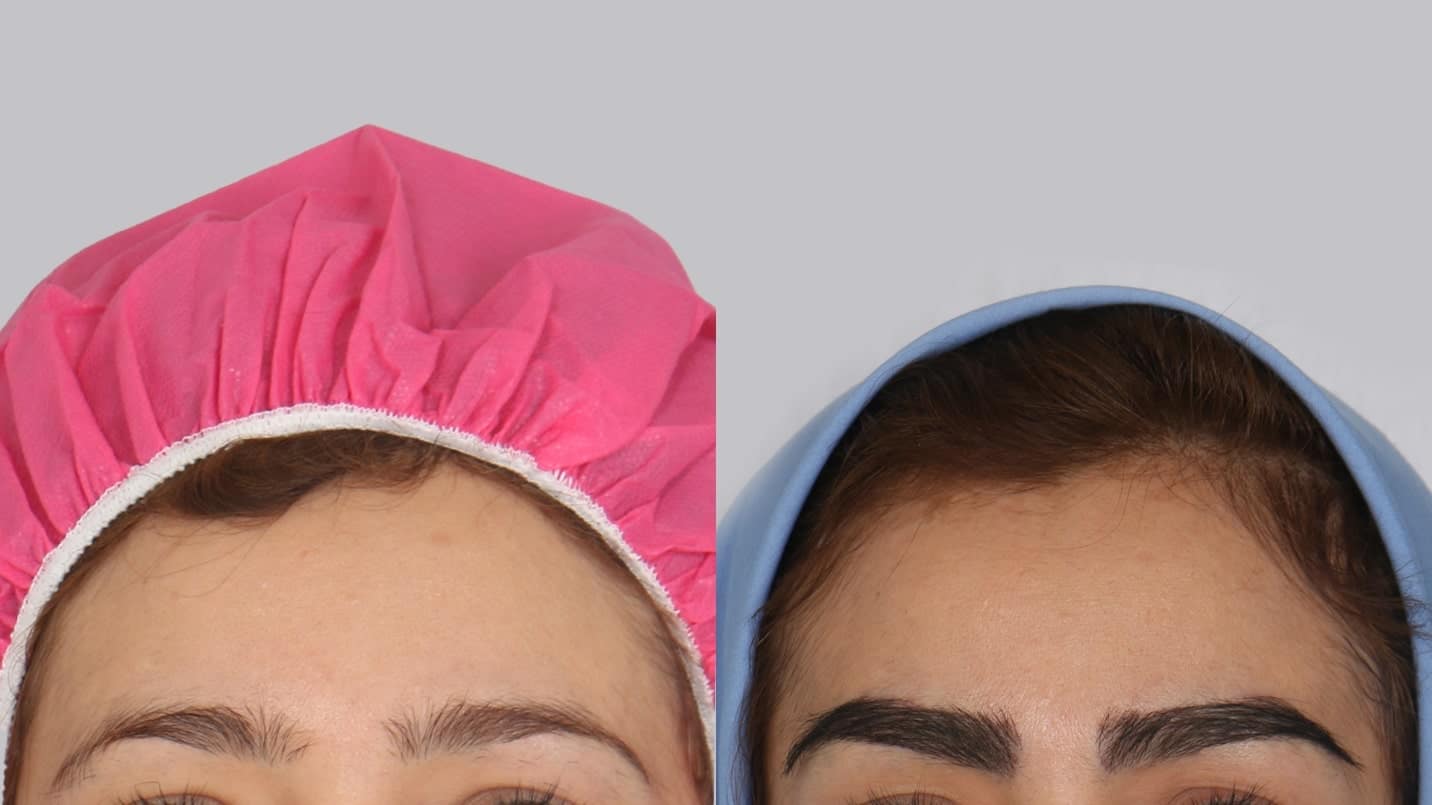 کاشت ابرو با جراحی بهتر است با بدون جراحی؛ کدام روش برای شما مناسب-تر است؟ - تصویر 1 کاشت ابرو با جراحی بهتر است با بدون جراحی؛ کدام روش برای شما مناسب تر است؟ تصویر 1
