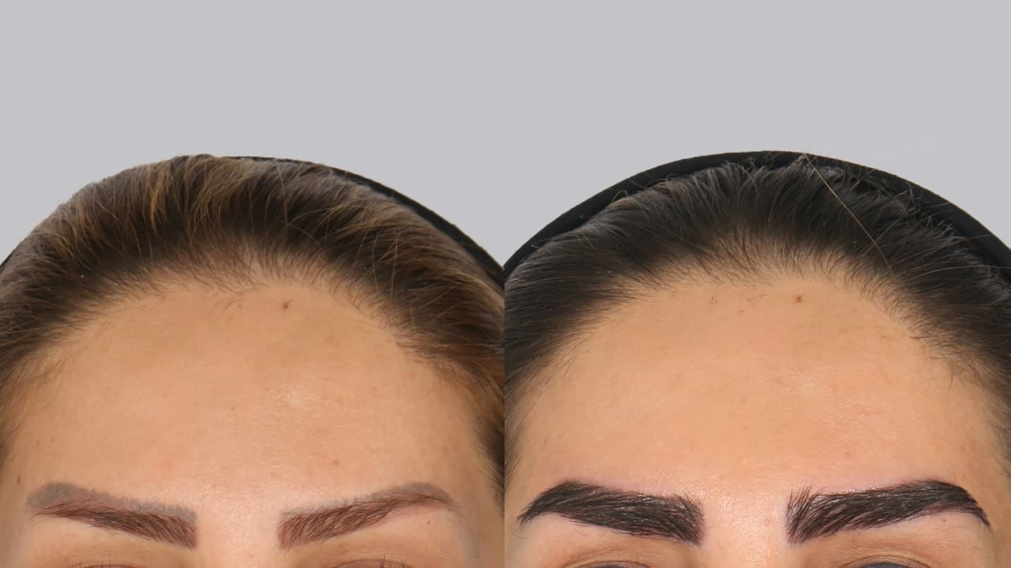 کاشت ابرو با جراحی بهتر است با بدون جراحی؛ کدام روش برای شما مناسب-تر است؟ - تصویر 2 کاشت ابرو با جراحی بهتر است با بدون جراحی؛ کدام روش برای شما مناسب تر است؟ تصویر 2