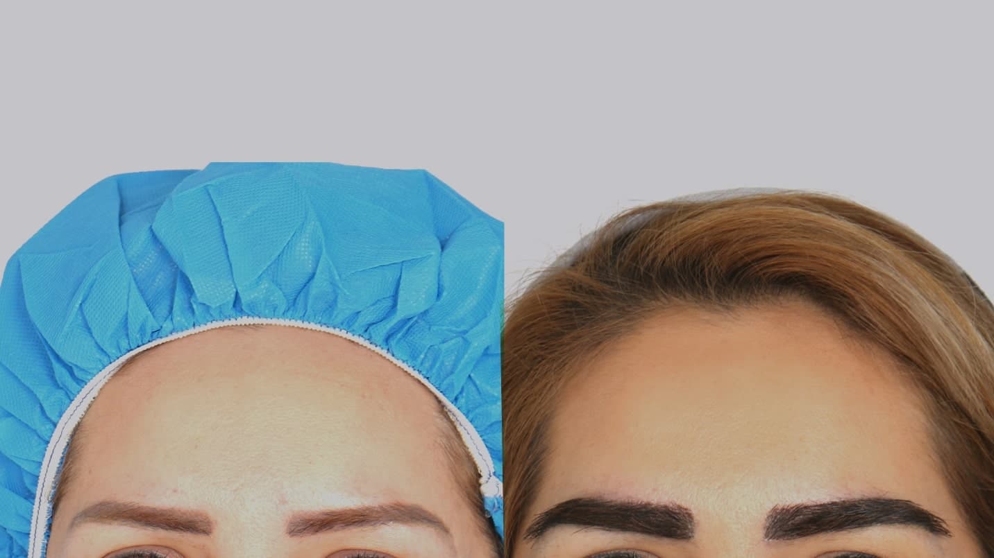 کاشت ابرو با جراحی بهتر است با بدون جراحی؛ کدام روش برای شما مناسب-تر است؟ - تصویر 3 کاشت ابرو با جراحی بهتر است با بدون جراحی؛ کدام روش برای شما مناسب تر است؟ تصویر 3
