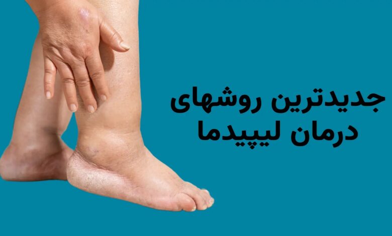 جدیدترین روش های درمان لیپیدما