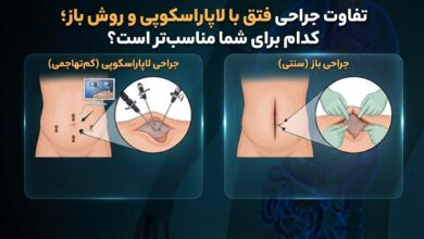 تفاوت جراحی فتق با لاپاراسکوپی و روش باز