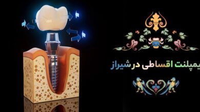 ایمپلنت اقساطی در شیراز