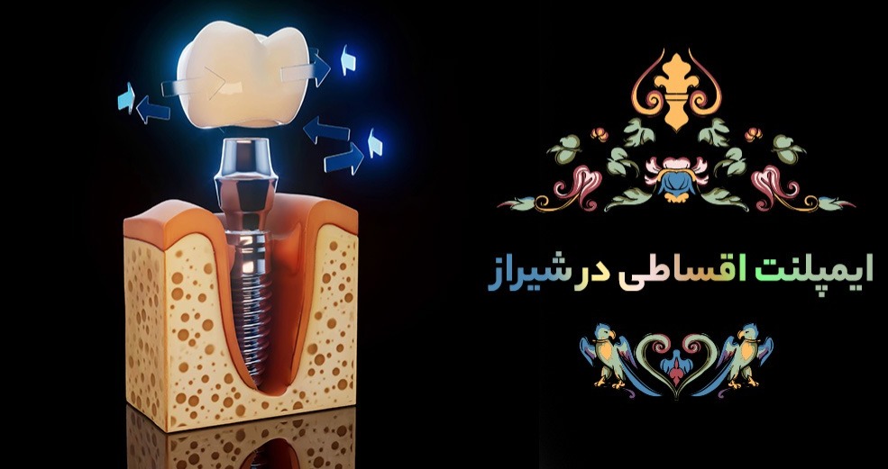ایمپلنت اقساطی در شیراز